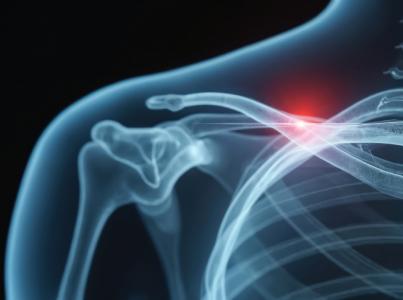 opération acromio claviculaire