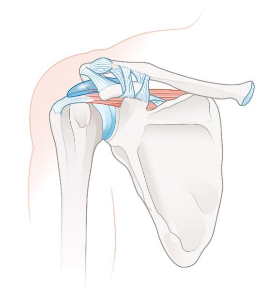 disjonction acromio-claviculaire